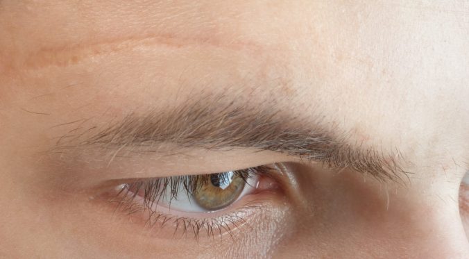 scar treatment Brisbane